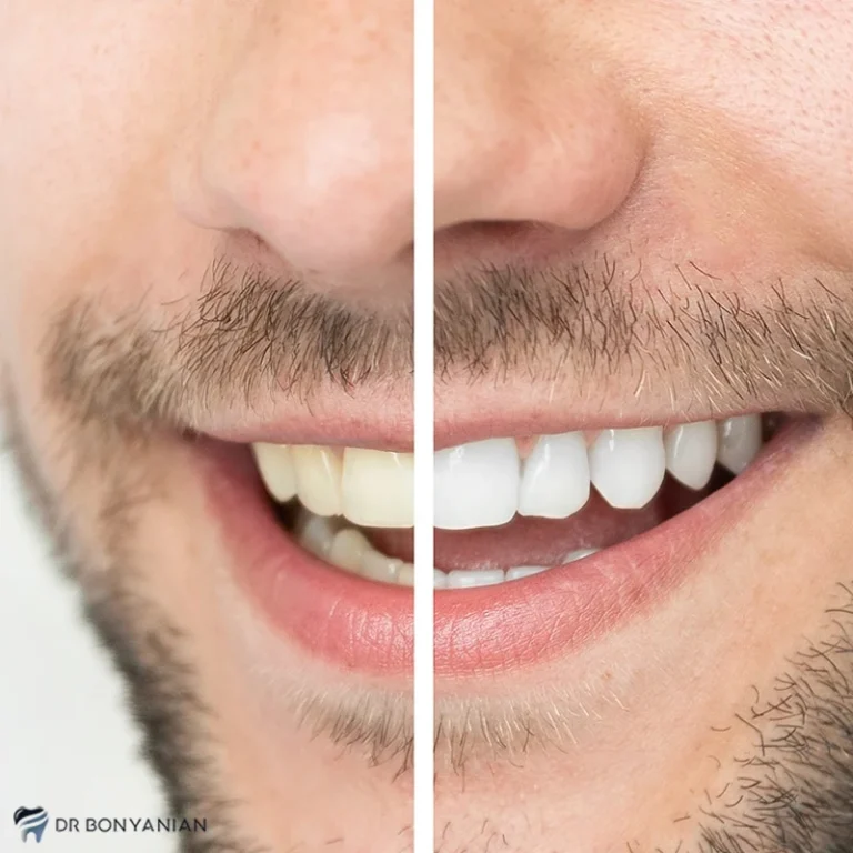 آیا بلیچینگ به مینای دندان آسیب میزند؟