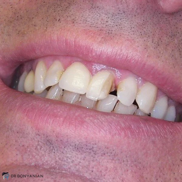 هنگام افتادن روکش دندان چه کار کنیم؟ دلایل افتادن روکش