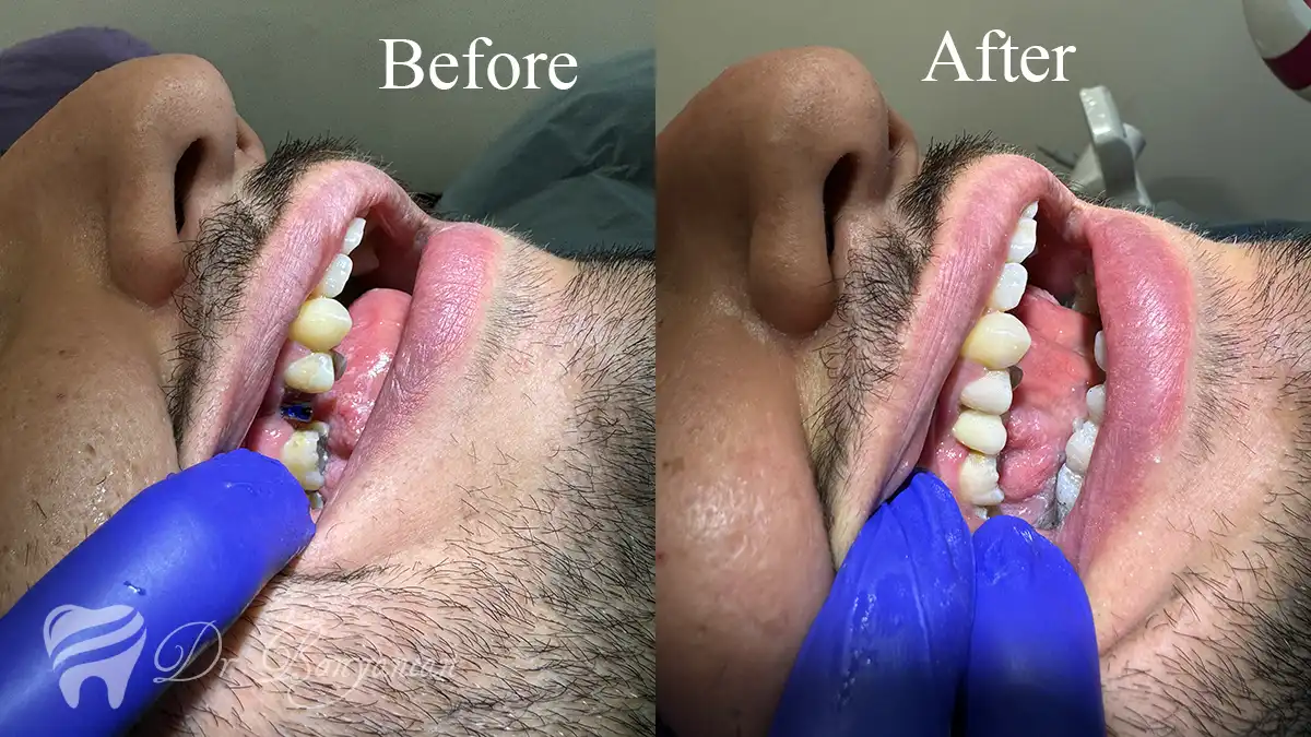 Dental implants — advantages over removable dentures, function and stability
