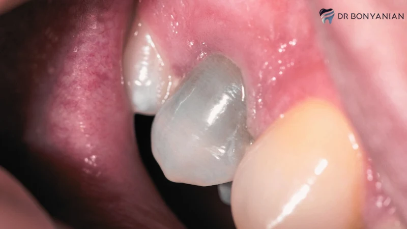 منظور از سیاه شدن رنگ دندان عصب کشی شده چیست؟