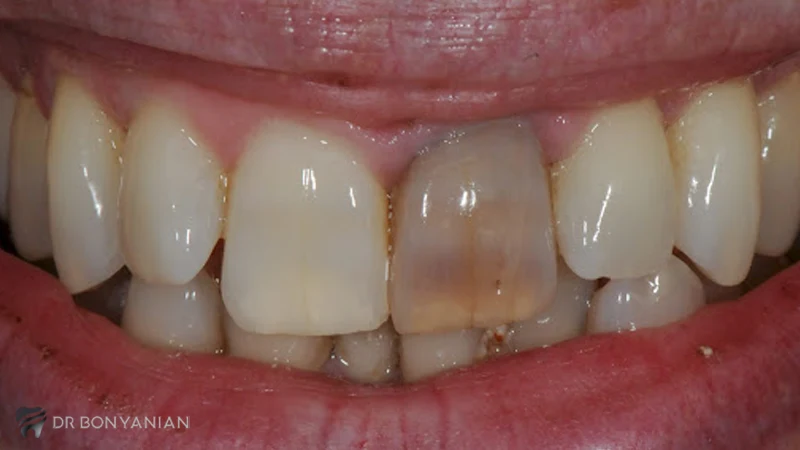 تخریب مواد آلی داخل دندان مانند عصب و پالپ