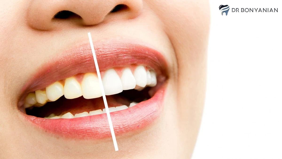 لک شدن کامپوزیت دندان