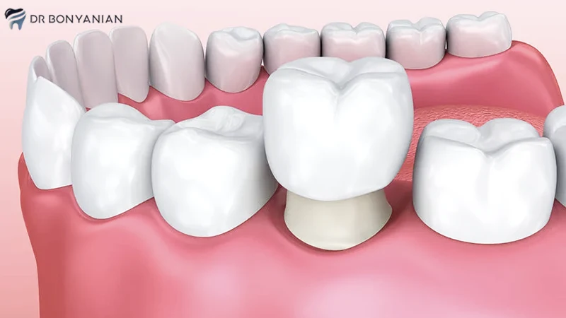 درمان سیاه شدن دندان عصب کشی شده با روکش دندان