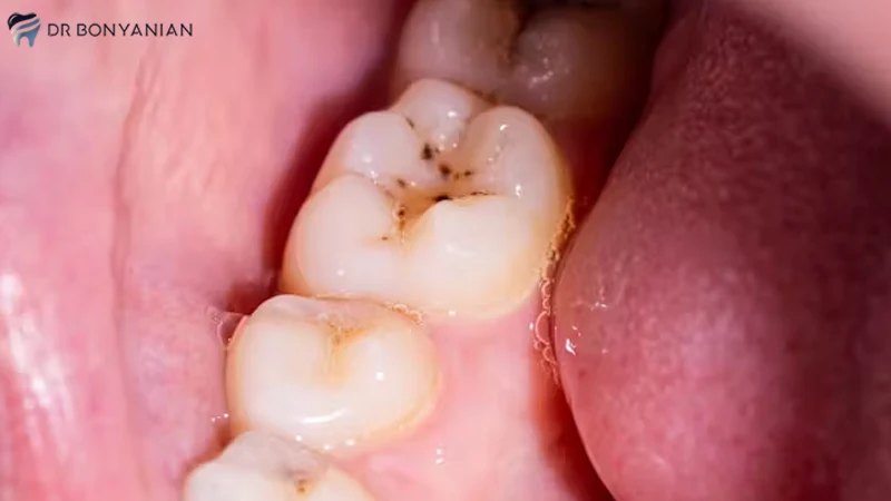 تغییر رنگ داخلی دندان