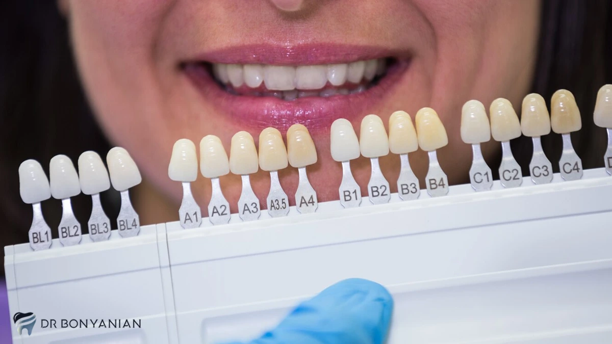 نحوه انتخاب رنگ کامپوزیت