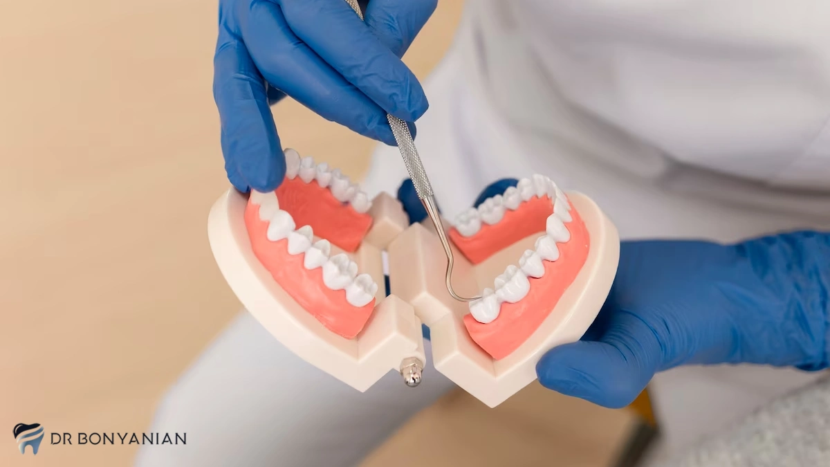 نحوه جراحی دندان عقل