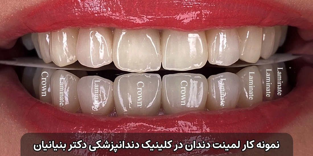 لمینت بهتر است یا کامپوزیت؟