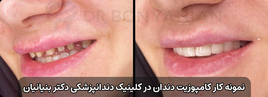 ونیر کامپوزیت دندان