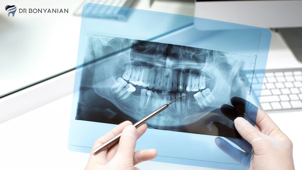 جراحی دندان عقل نهفته روی عصب