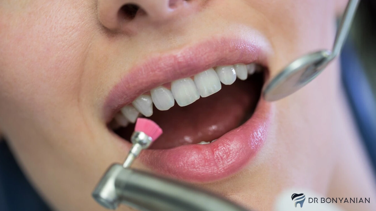 ونیر کامپوزیت دندان