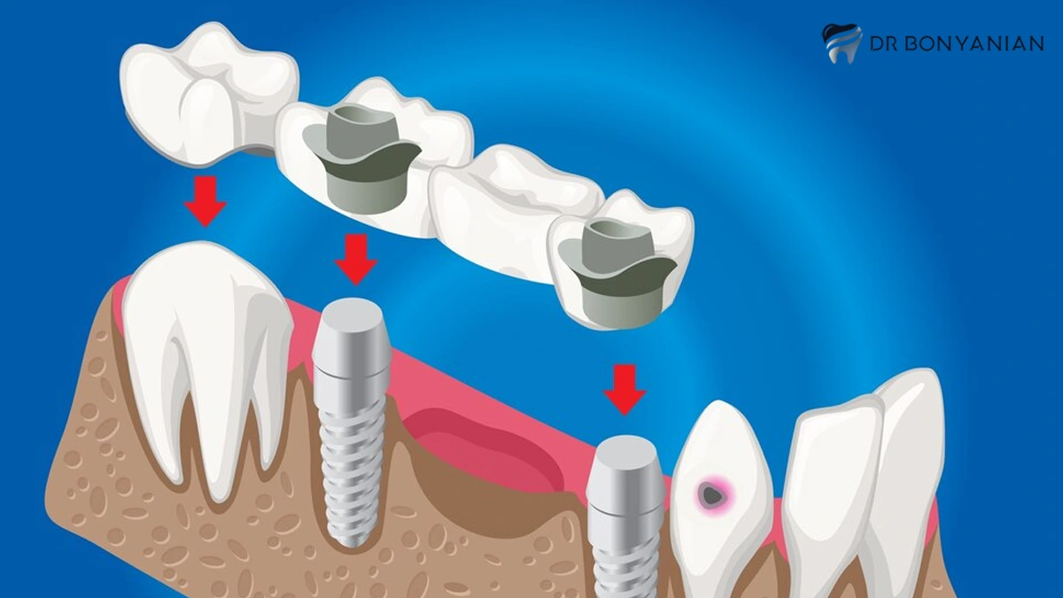 عوارض پروتز دندان چیست؟
