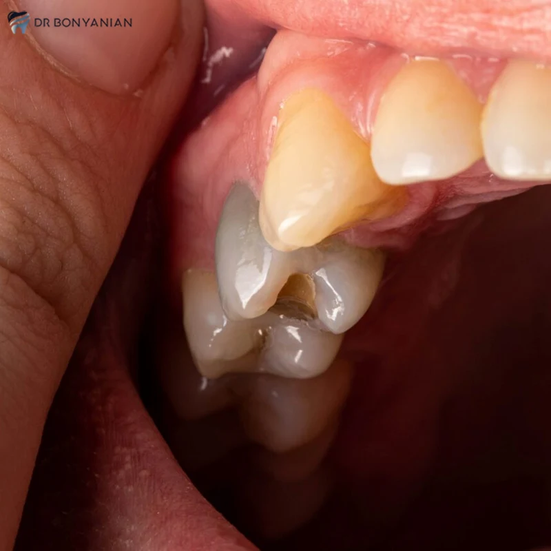 دلایل تغییر رنگ (سیاه شدن) دندان بعد از عصب کشی