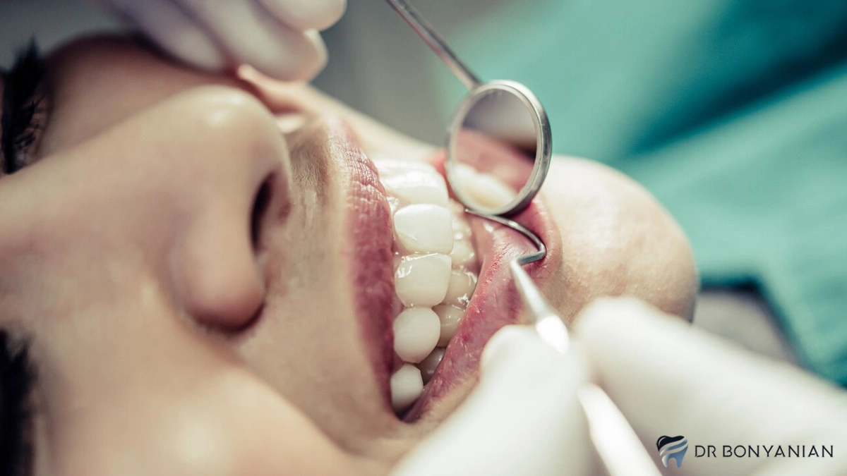 جراحی لثه برای نصب روکش