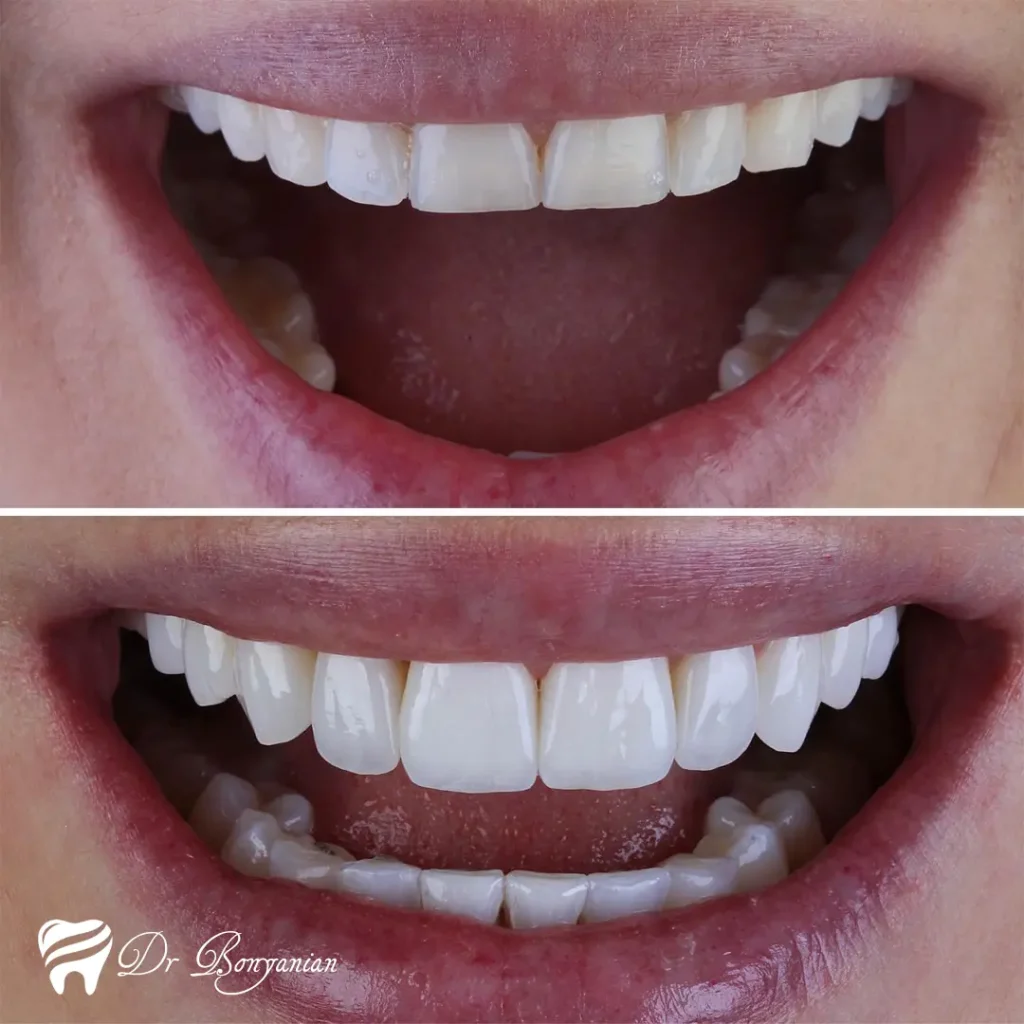 عکس قبل و بعد لمینت دندان