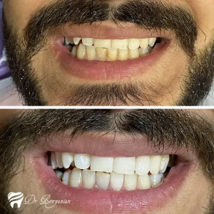 عکس قبل و بعد بلیچینگ دندان