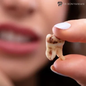 پوسیدگی دندان: روشهای ترمیم، هزینهها و مراقبتهای پس از درمان