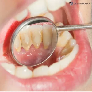 دلایل لق شدن یا افتادن کامپوزیت دندان