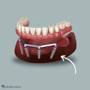 پروتز دندان بدون کام