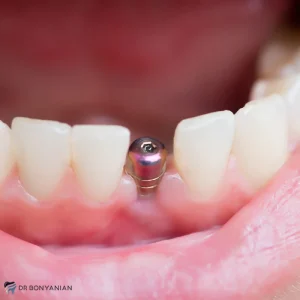 قالب گیری دندان ایمپلنت چقدر طول میکشد؟