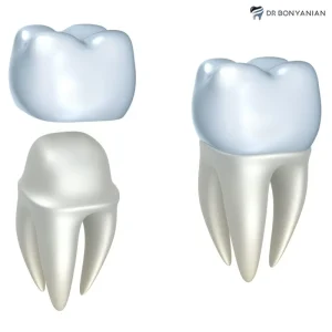 ساخت روکش کامل ایمپلنت چند روز طول میکشد؟