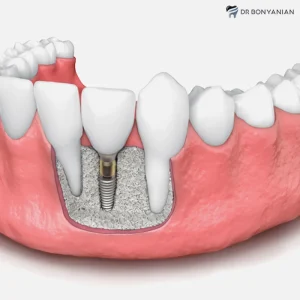 ایمپلنت بعد از پودر استخوان بعد از ۶ ماه