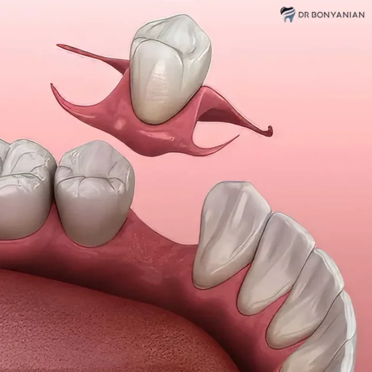 پروتز ثابت دندان مصنوعی تکی چسبی + مزایا و معایب