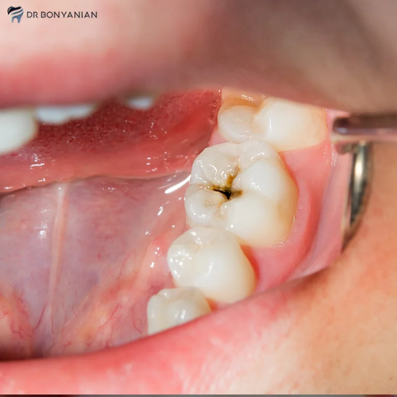 چقدر طول میکشد پوسیدگی دندان به عصب برسد؟