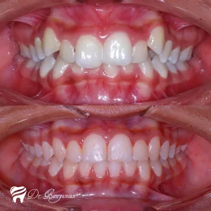 Photo before and after orthodontics