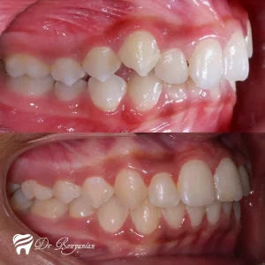 Photo before and after orthodontics