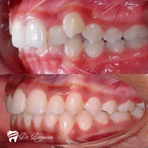 Photo before and after orthodontics