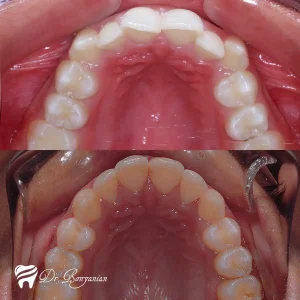 Photo before and after orthodontics