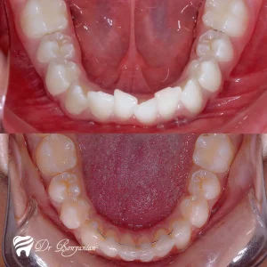 Photo before and after orthodontics