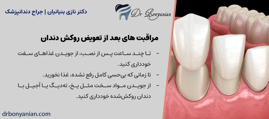 مراقبت های بعد از تعویض روکش دندان
