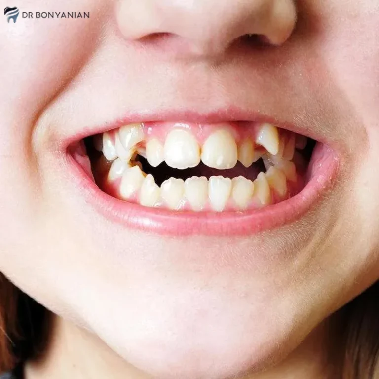 چگونه دندان کج را در خانه صاف کنیم؟
