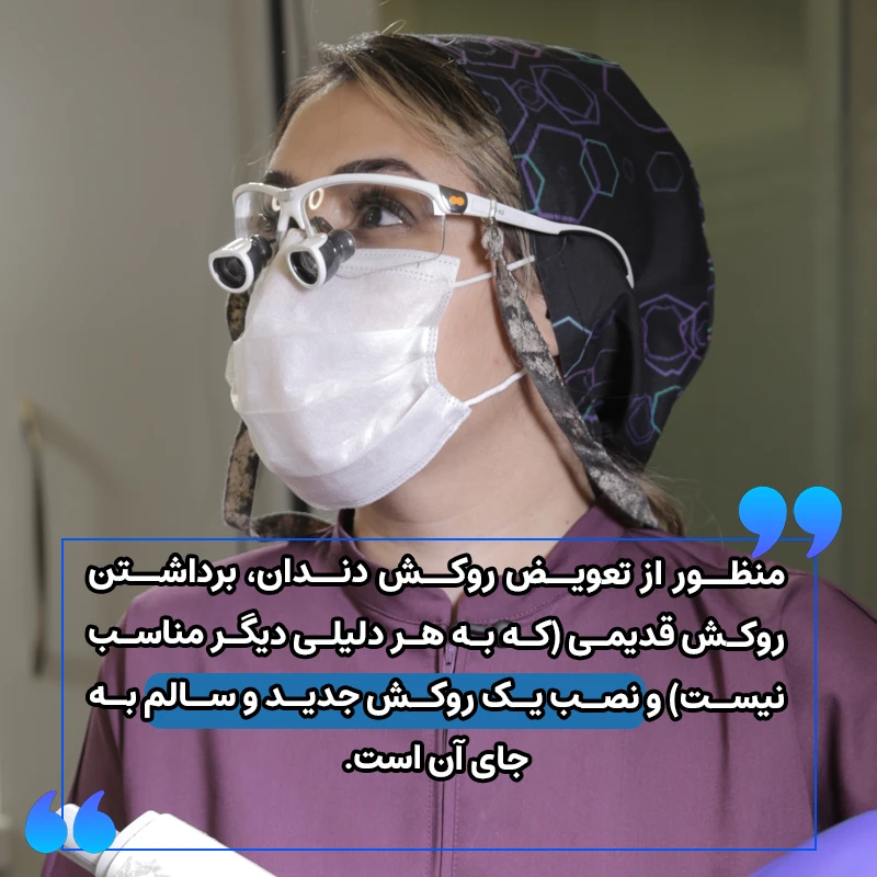 منظور از تعویض روکش دندان چیست؟