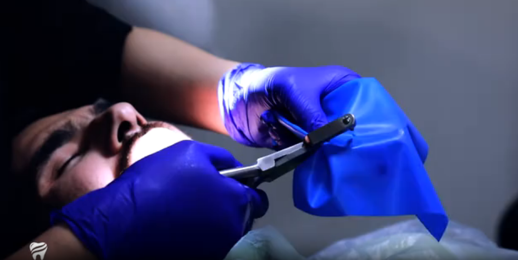 فیلم نحوه عصب کشی دندان