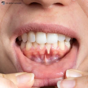 عقبنشینی لثه یا تحلیل لثه چیست؟