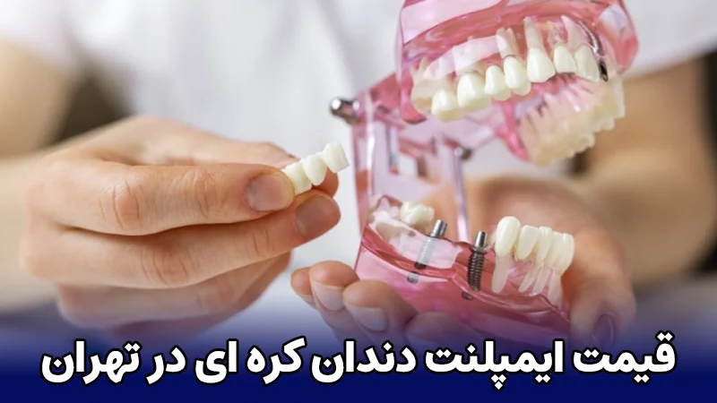 قیمت انواع ایمپلنت های کره ای در تهران در سال 1404 (دندانپزشکی دکتر بنیانیان)