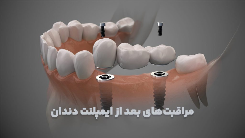 مراقبت های بعد ایمپلنت
