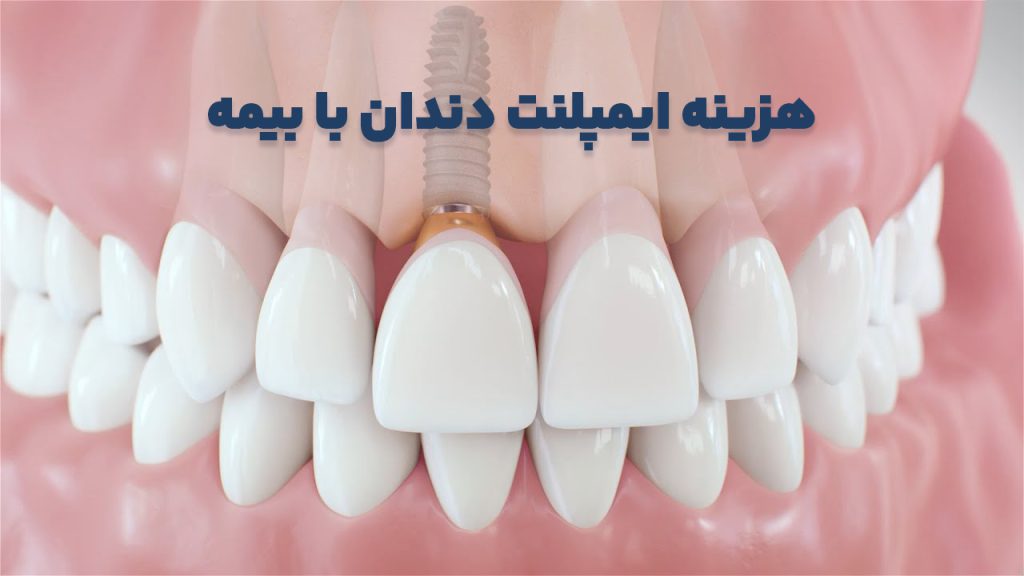 هزینه ایمپلنتدندان با بیمه