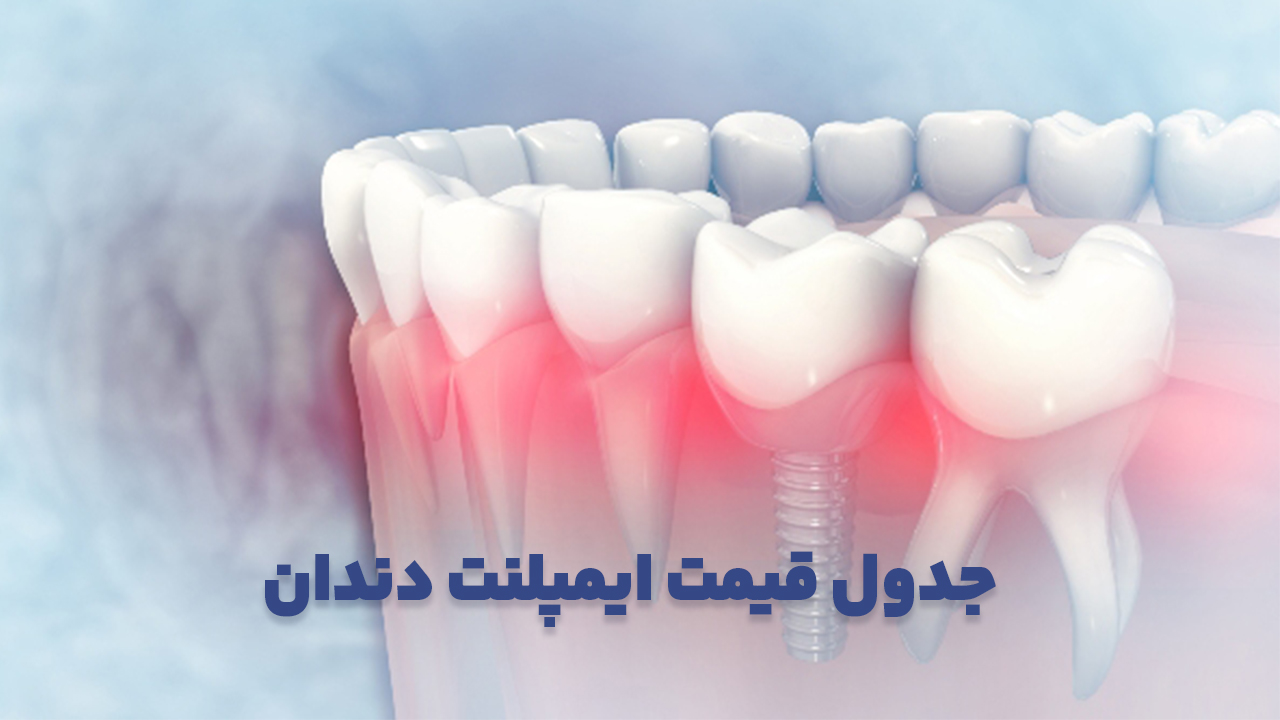 جدول قیمت ایمپلنت دندان