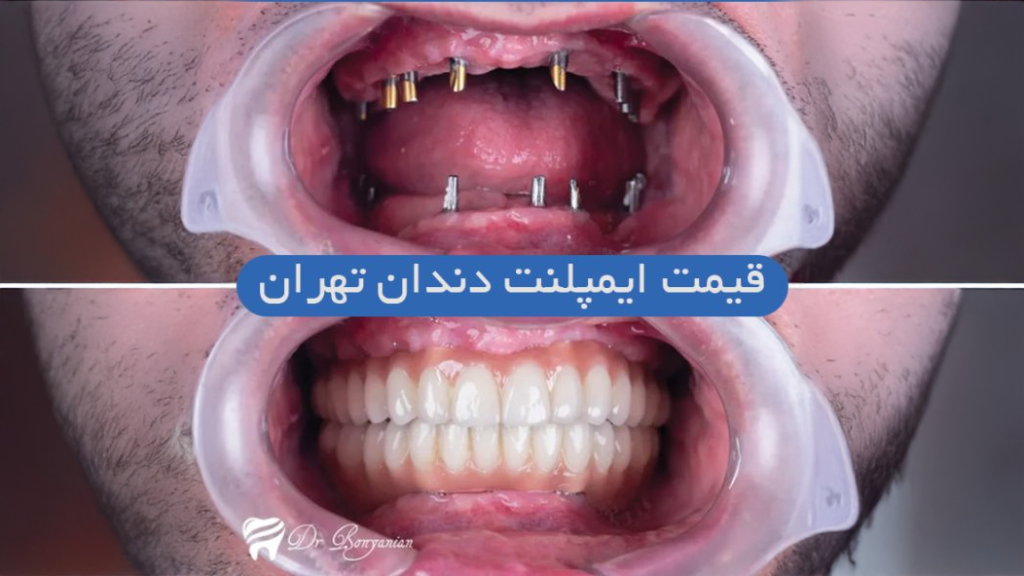 تصویر از قبل و بعد ایمپلنت دندان به همراه قیمت ایمپلنت