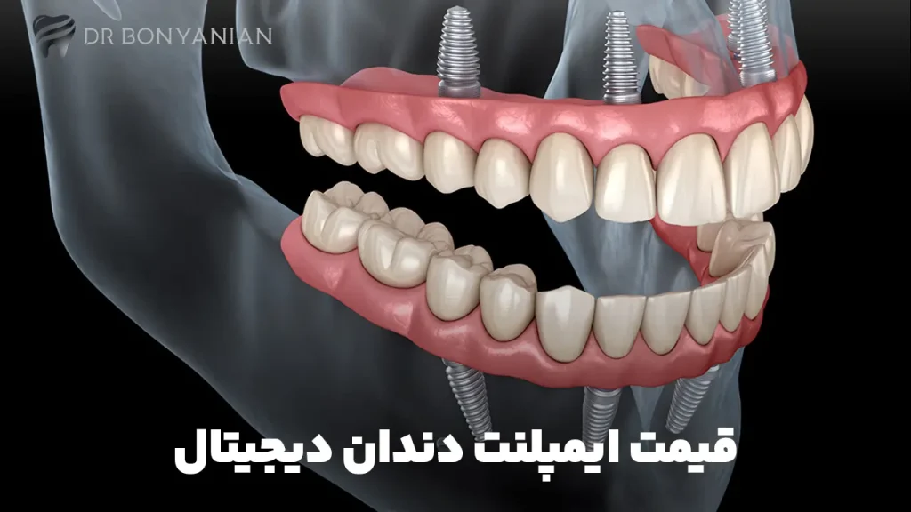 قیمت ایمپلنت دندان دیجیتال در سال ۱۴۰۴