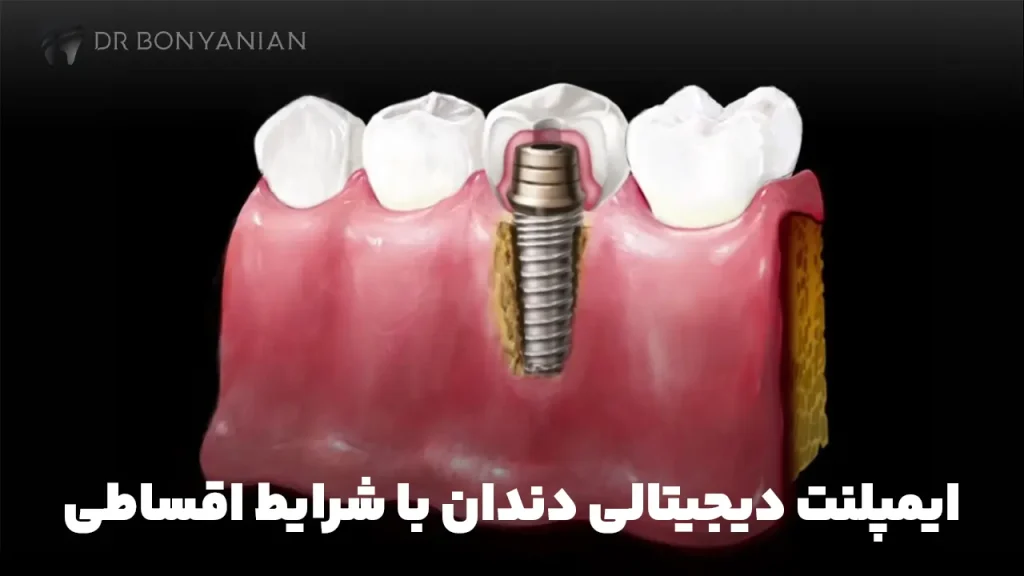 ایمپلنت دیجیتالی دندان با شرایط اقساط