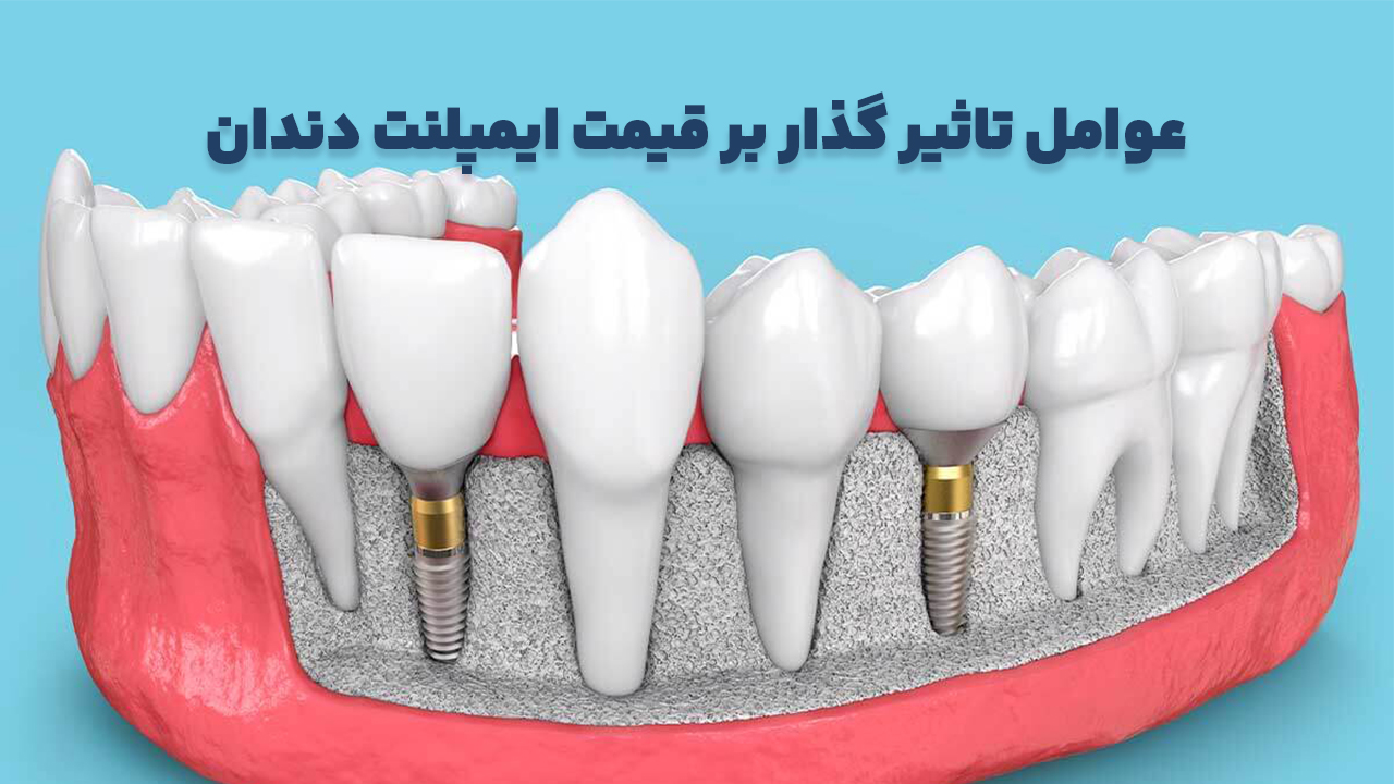 عوامل موثر بر قیمت ایمپلنت دندان
