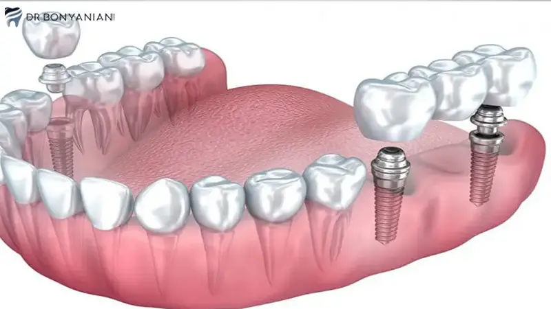عمر ایمپلنت آلمانی بگو