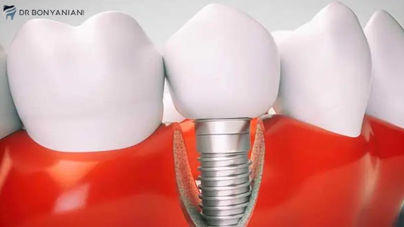 فیکسچرهای ایمپلنت بگو