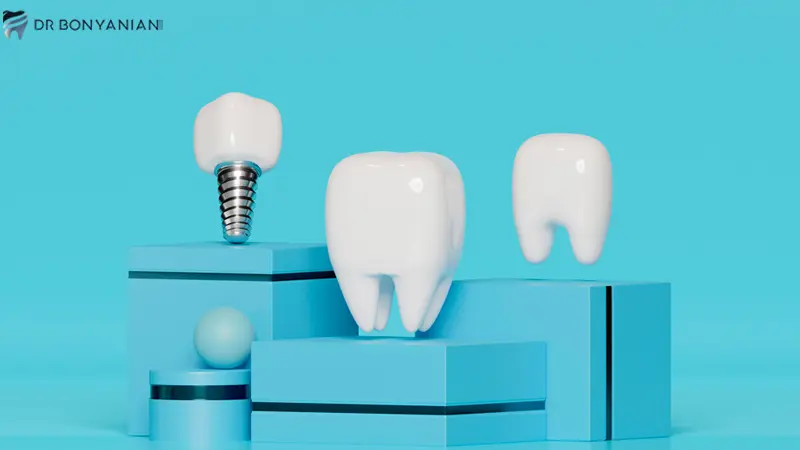 آشنایی با ایمپلنت دندان BEGO