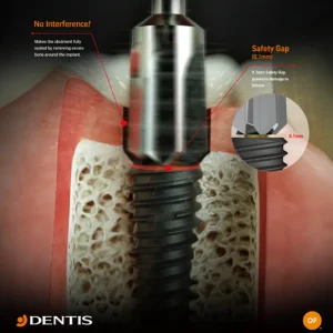 ایمپلنت کره ای دنتیس