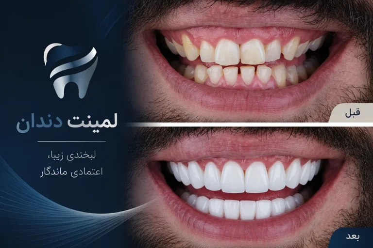 لمینت دندان در تهران